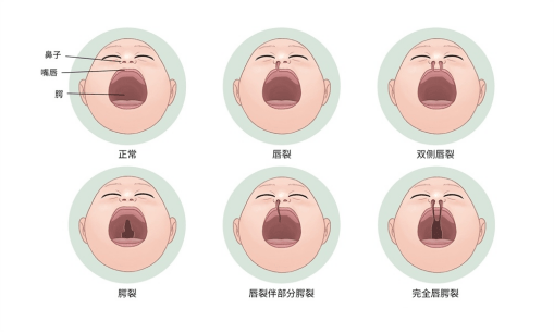 华为手机屏幕碎了能修复吗
:做了唇裂鼻畸形修复，就能和正常人一模一样吗？